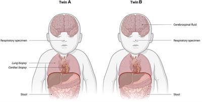 Severe neonatal enterovirus infection in twins with different outcomes: A case report